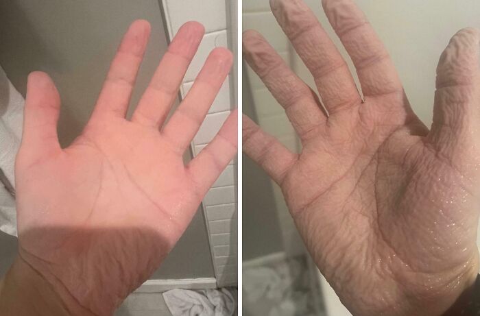 Had A Bath, Both Hands Were In For The Same Amount Of Time. Yet The Arm In The Sling Is Far More Wrinkled