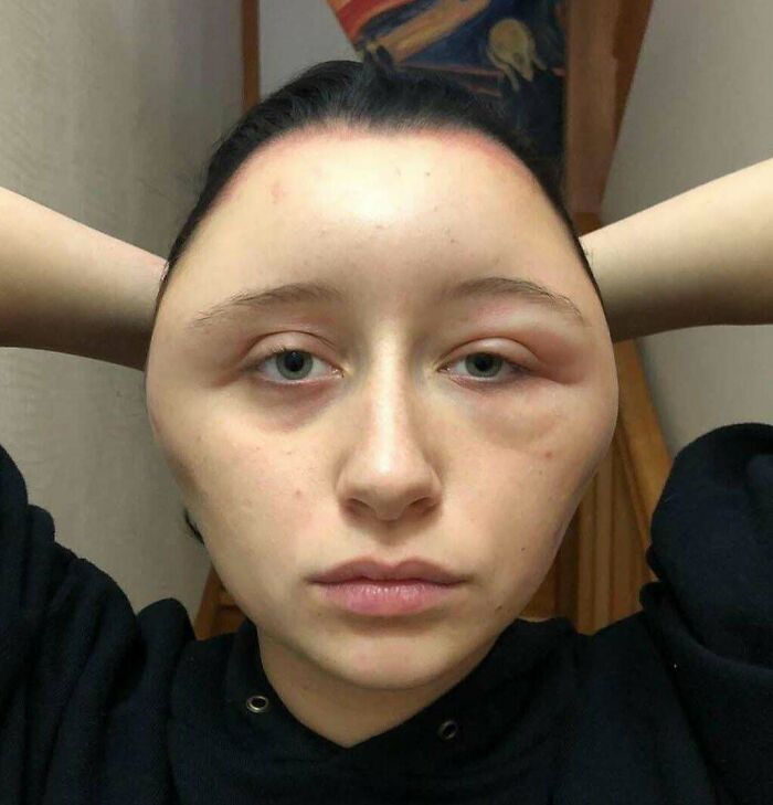 Woman with distorted, unusually wide face posing with hands behind head, one eye swollen in a weird and unexplainable image.