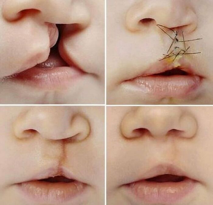 Close-up collage showing stages of a medical procedure repairing a cleft lip in an infant, unusual medical photos.