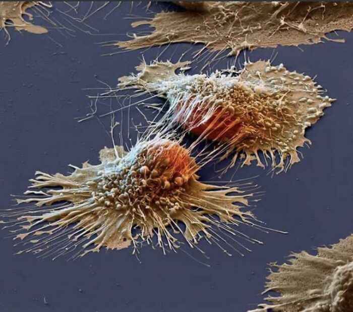 Cancer Cells Under An Electron Microscope