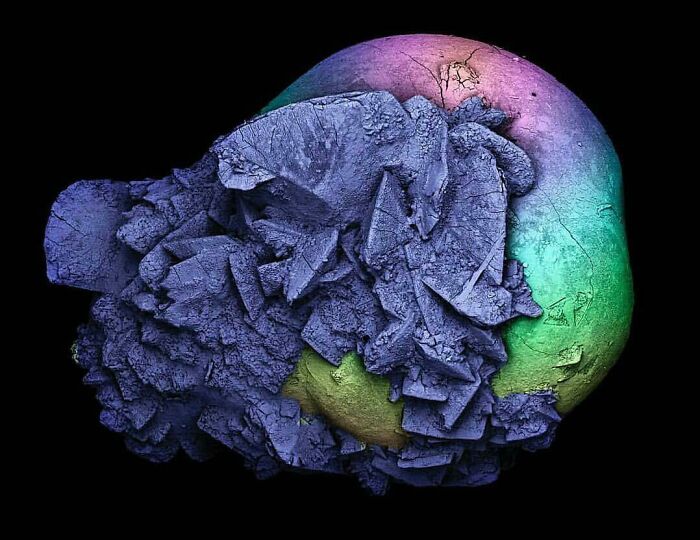 Kidney Stones Under A Microscope. Size 2 Mm