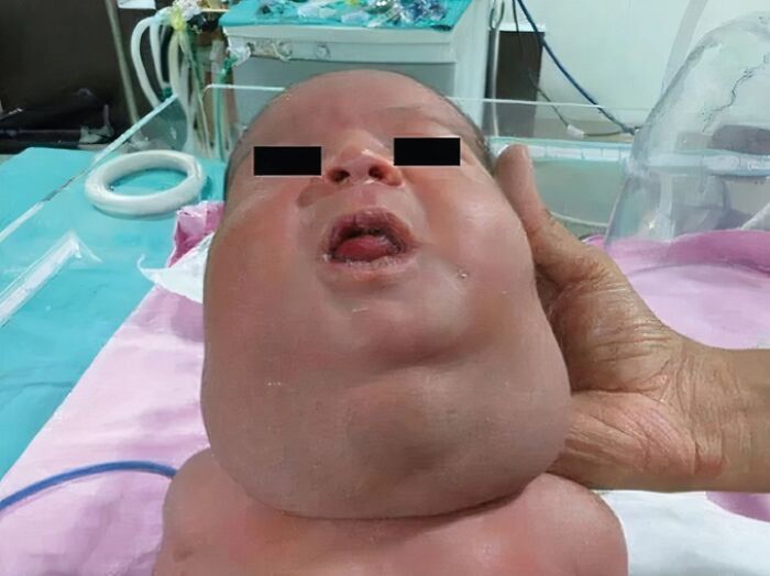 Unusual medical photo of a patient with extreme facial swelling, highlighting rare and shocking medical conditions.