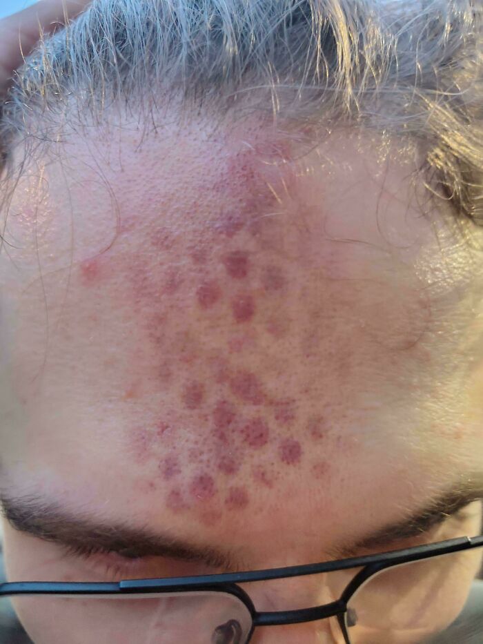 This Bruise On My Friend's Forehead After Hitting It Into A Speaker