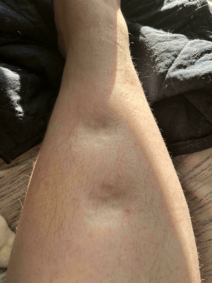 My Cat Stood On My Leg And Left Paw Imprints