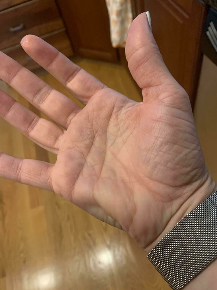 I Got A Cramp In The Side Of My Hand, And You Can Actually See It