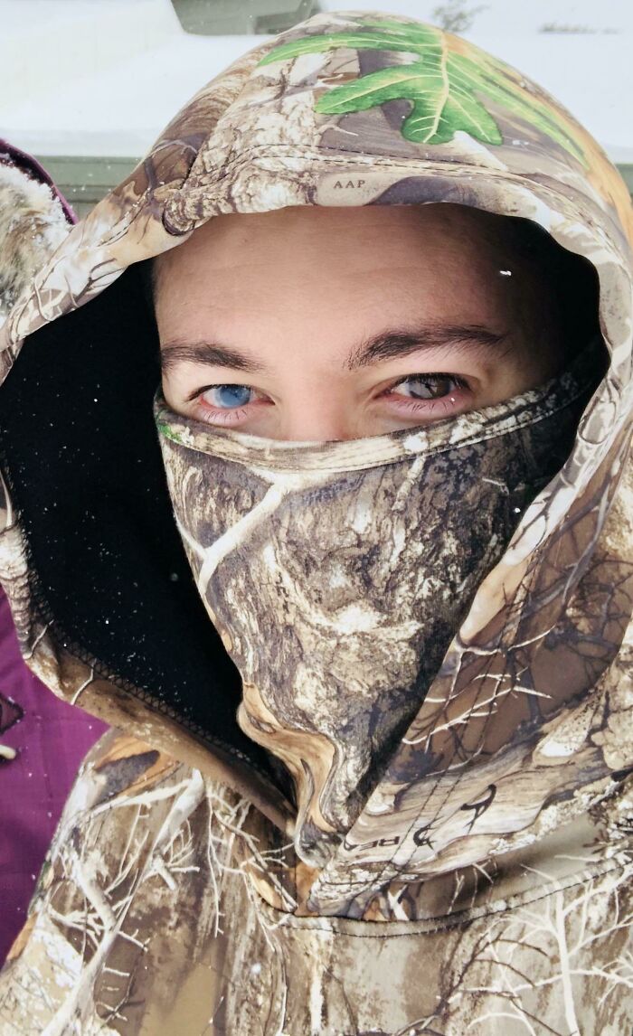 I Got An Eye Injury 6-Years-Ago That Left My Right Eye Blue Now Instead Of The Original Brown