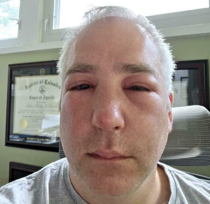 Got Stung By A Bee On My Nose And Now I Look Like I Lost A Boxing Match