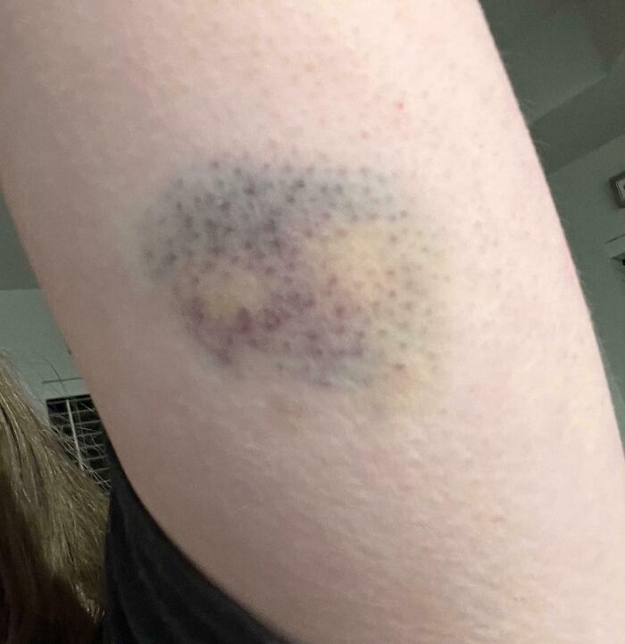 My Dog Jumped At Me And It Left A Bruise Shaped Just Like His Nose