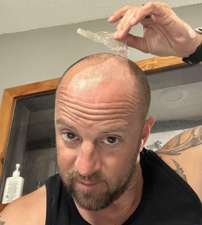 Sunburned My Bald Head. Peeled Off In Big Pieces
