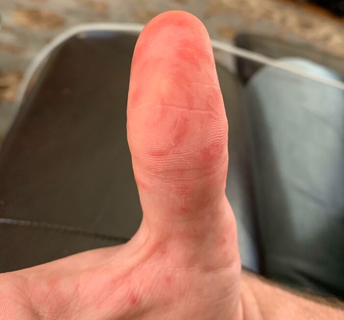 Recently Came Down With Hand, Foot, And Mouth Disease. The Rashes On My Fingers Follow My Fingerprints