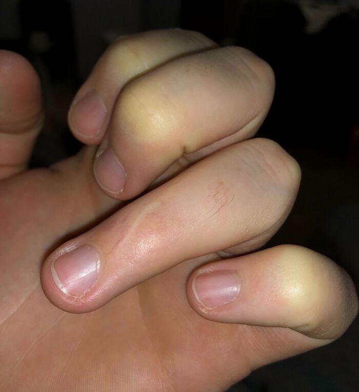 My Left Ring Finger Doesn’t Have Creases Because I Haven’t Been Able To Bend It In Over 13 Years. Scar Is Unrelated To Injury