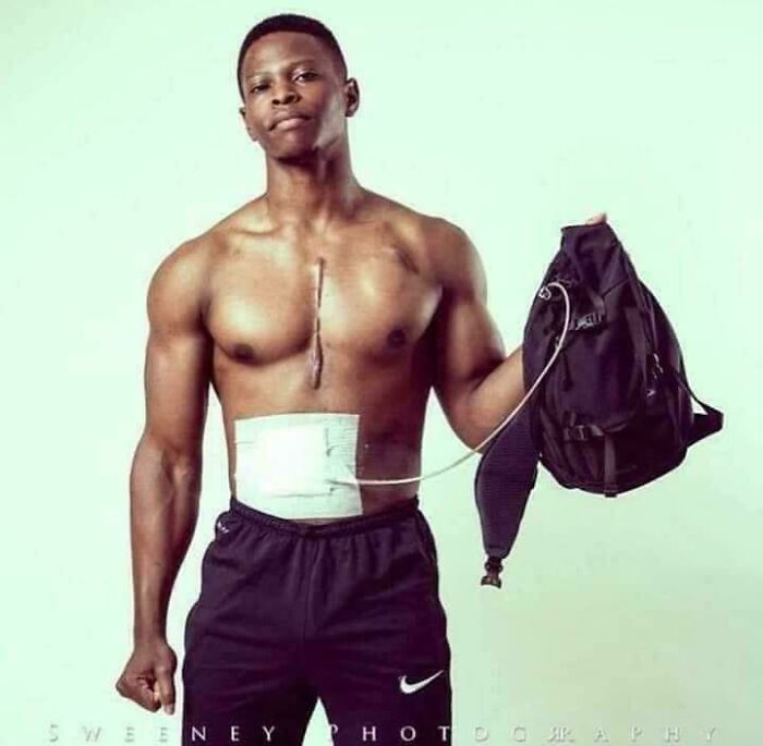 Young man showing medical ostomy bag connected to backpack tube, representing interesting vault stories and oddities.