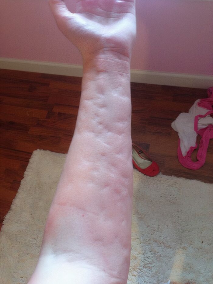 I Have Cold Urticaria, Hives Caused By The Cold. This Is My Arm After A Run In Rainy 45 Degree Weather