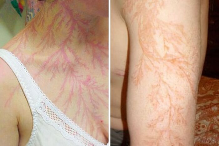The Scars On The Bodies Of Those Who Survived A Lightning Strike