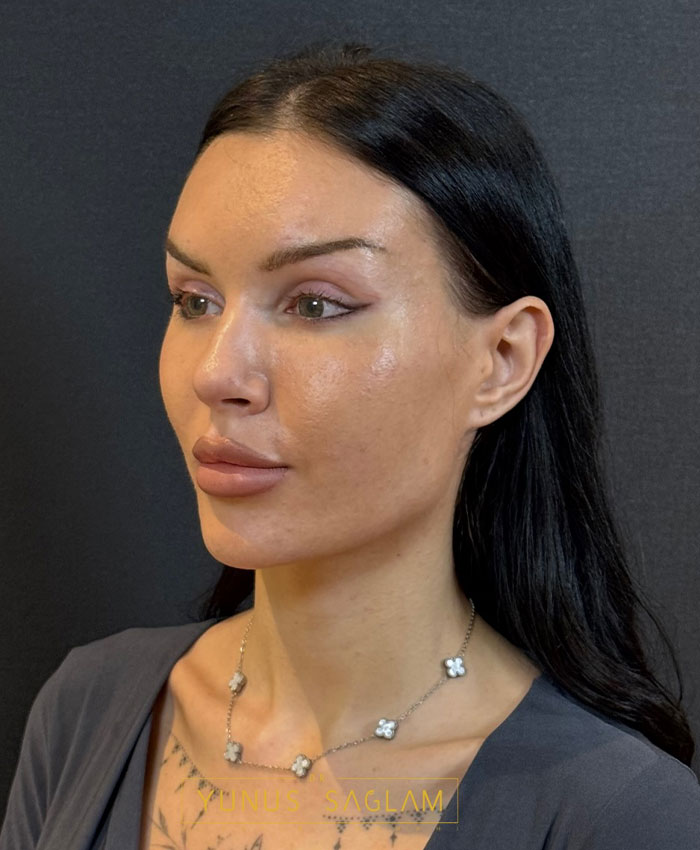 Woman with cosmetic procedure showing before-and-after changes, highlighting cosmetic procedure details and effects.