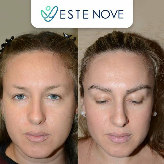 Before and after hair transplant results on a woman showing the effectiveness of professional hair transplant surgery.