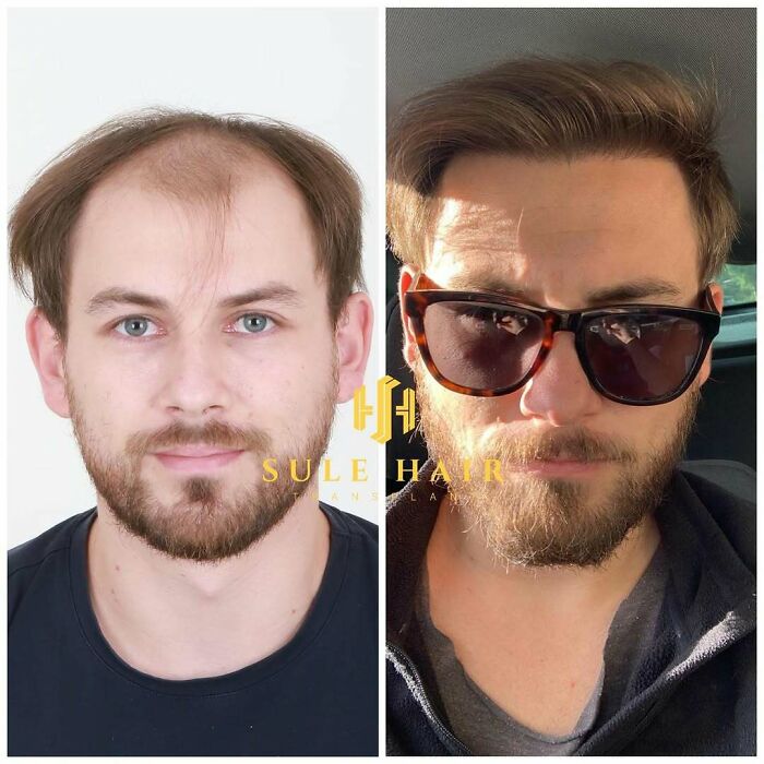 Before and after hair transplant results on a man showing improved hair density and restored hairline with sunglasses.
