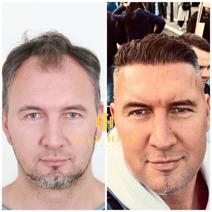 Before and after hair transplant photos showing improved hair density and hairline restoration on a man’s face.