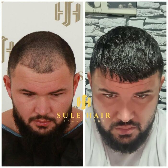 Before and after hair transplant showing improved hair density and coverage on a man's scalp with dark hair and beard.