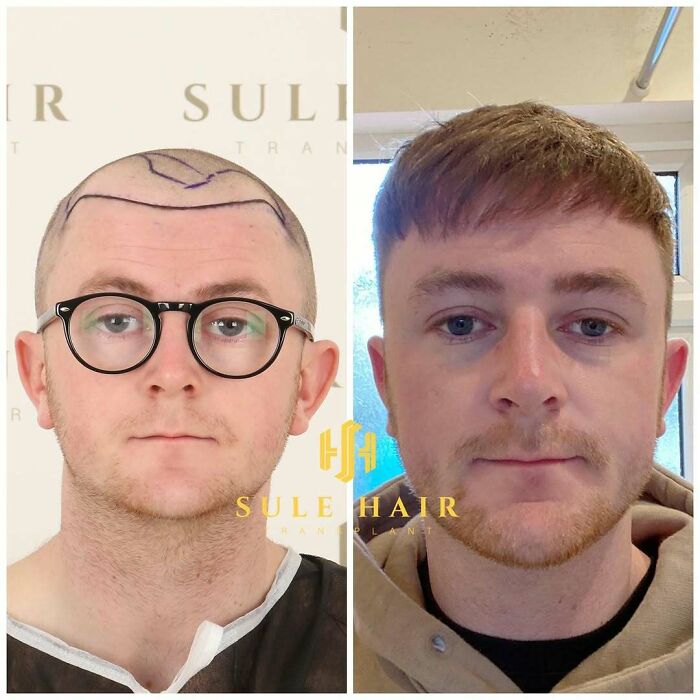 Before and after photos showing hair transplant results on a man with restored hairline and fuller hair growth.