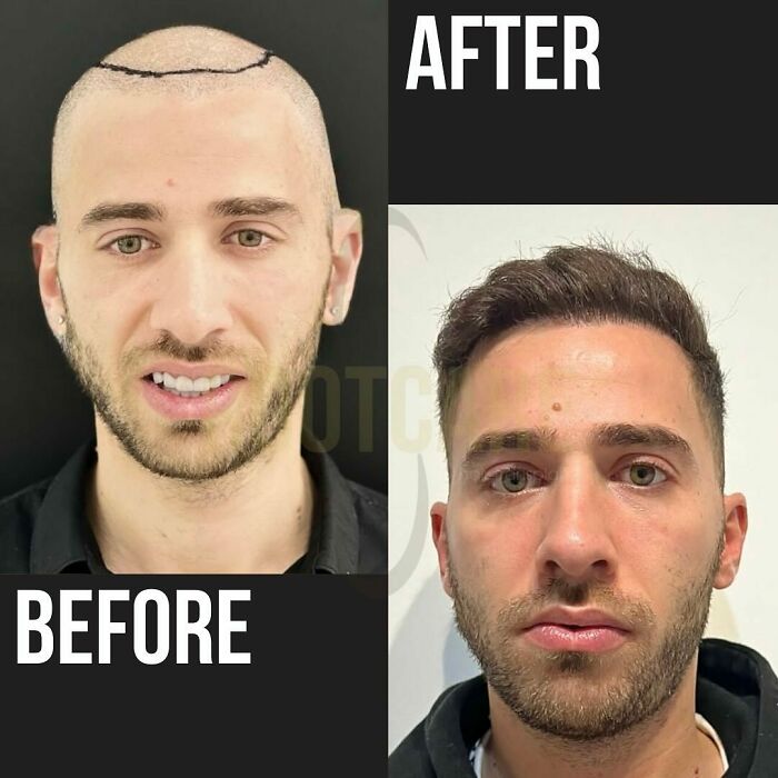 Before and after hair transplant photos showing a man with restored hairline and thicker hair after the procedure.