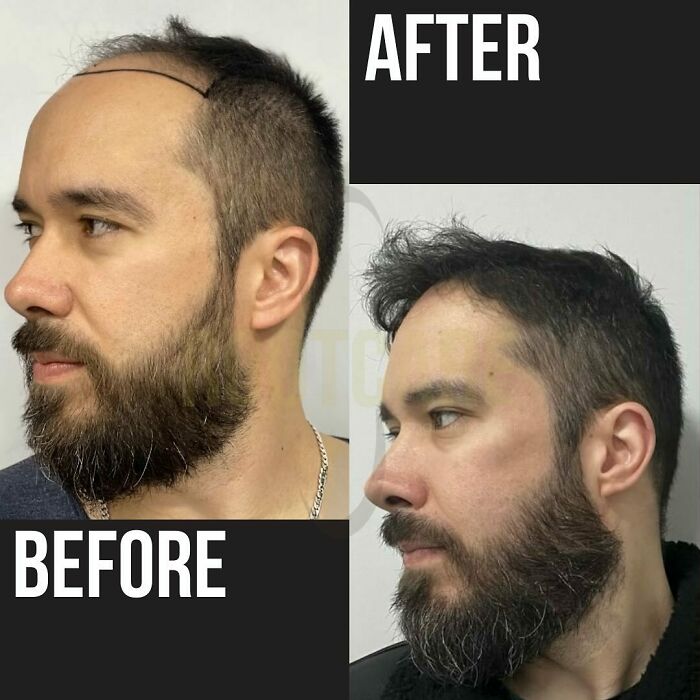 Before and after photos of a man showing hair transplant results with significant hair restoration on the scalp.