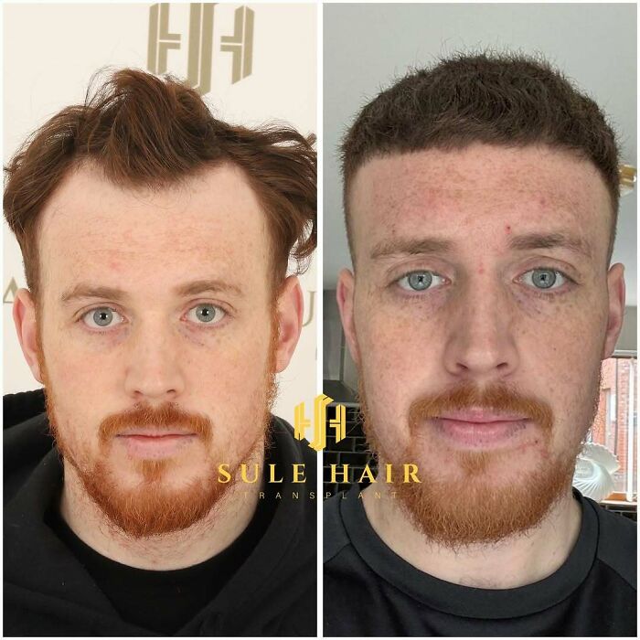 Before and after hair transplant showing improved hairline and density on a red-bearded man with light skin and blue eyes.