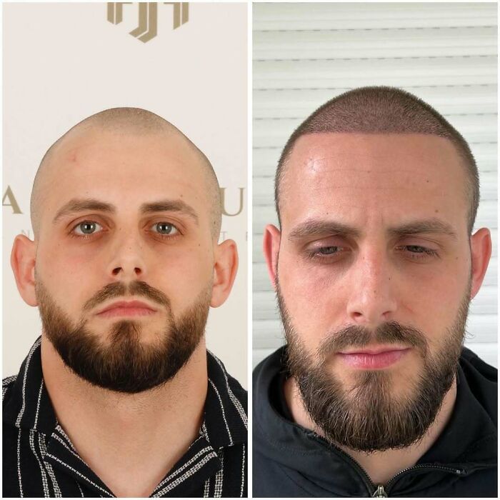 Before and after photos showing hair transplant results on a man with restored hairline and fuller scalp coverage.