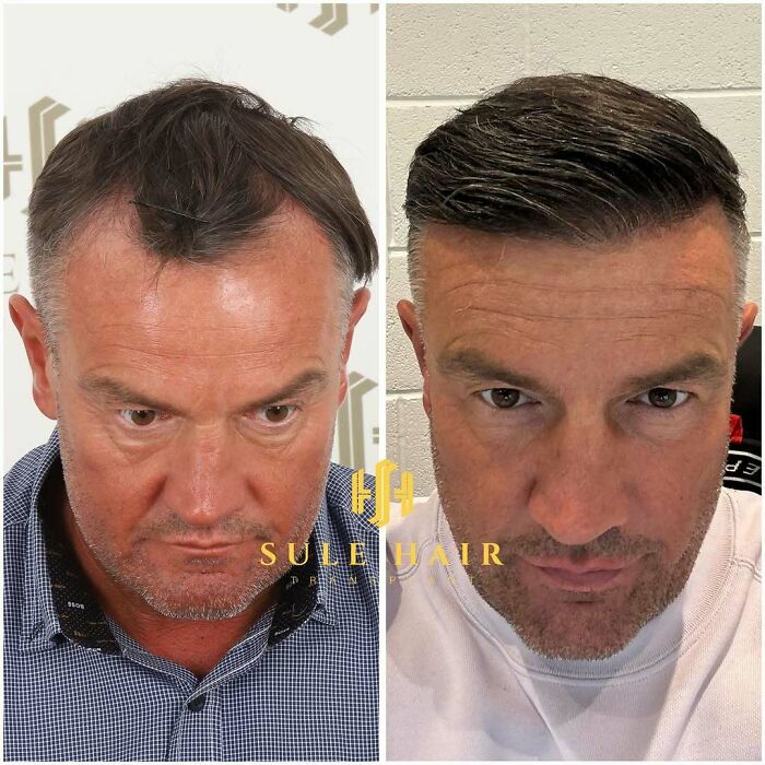 Before and after images of a hair transplant showing improved hair density and hairline restoration for a middle-aged man.