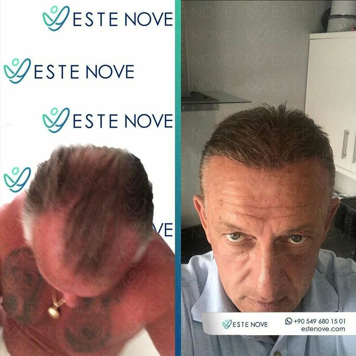 Before and after hair transplant photos showing significant improvement in hair density and coverage on a middle-aged man's scalp.