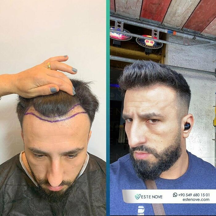 Before and after hair transplant photos showing restored hairline and improved hair density on a man’s scalp.