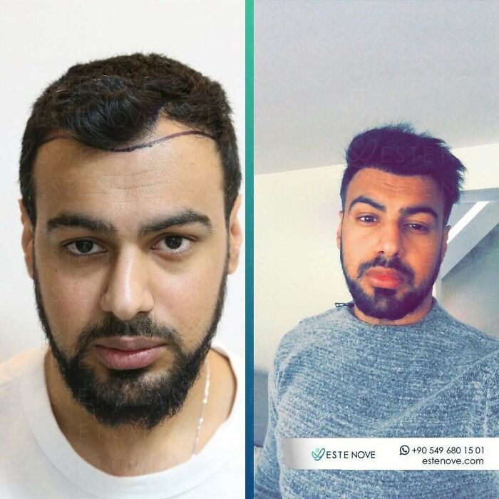 Before and after photos showing results of a hair transplant procedure on a man's hairline and scalp.