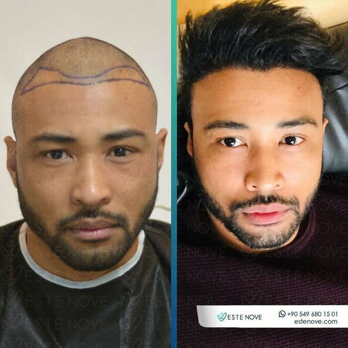 Before and after hair transplant photos showing significant hair restoration results on a male patient’s scalp.