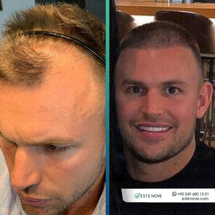 Before and after photos showing dramatic hair transplant results on a man with improved hair density and hairline restoration.