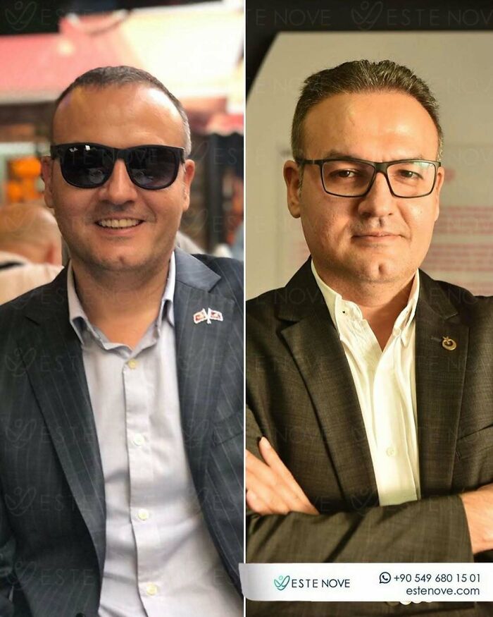 Before and after hair transplant photos of a man showing improved hair density and natural results from surgeons.