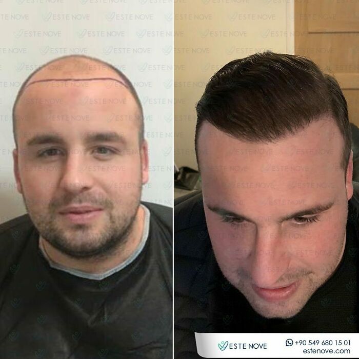 Before and after hair transplant results showing restored hairline and improved hair density on a male patient.