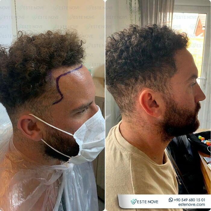 Before and after hair transplant photos showing restored hairline and improved hair density on a man's head.