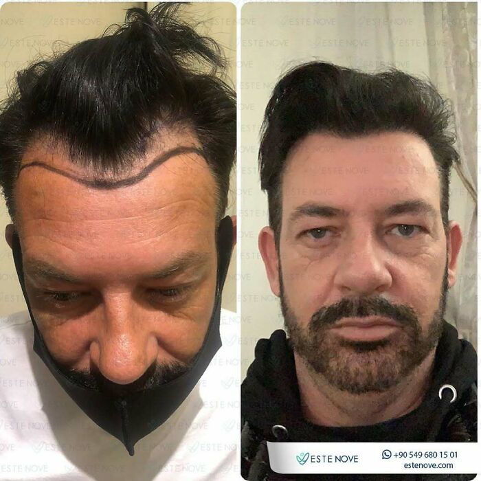 Before and after hair transplant results showing improved hairline and fuller hair in a male patient.