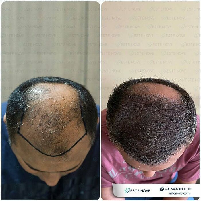 Before and after hair transplant showing improved hair density and coverage on a man's scalp from a surgeon's results.