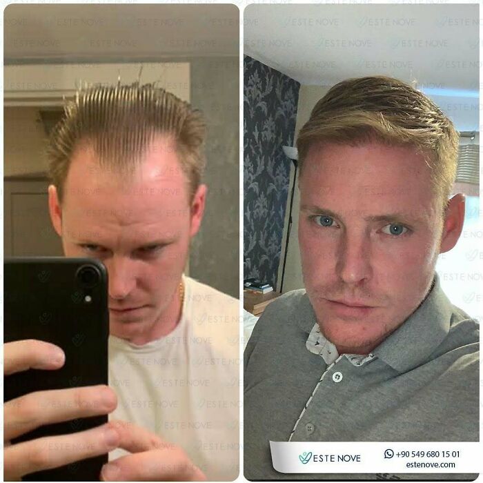 Before and after images showing hair transplant results with noticeable improvement in hair density and hairline restoration.