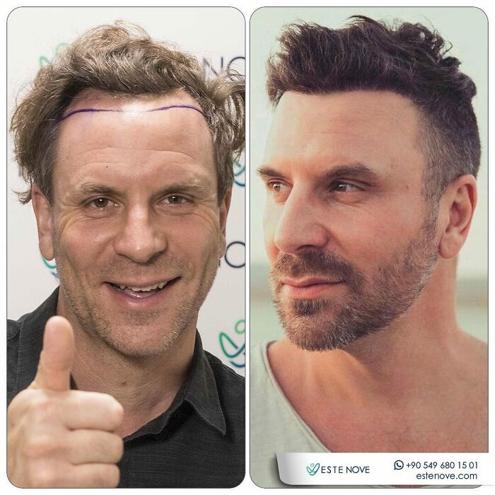 Before and after hair transplant photos showing improved hairline and thicker hair on a smiling man giving thumbs up.