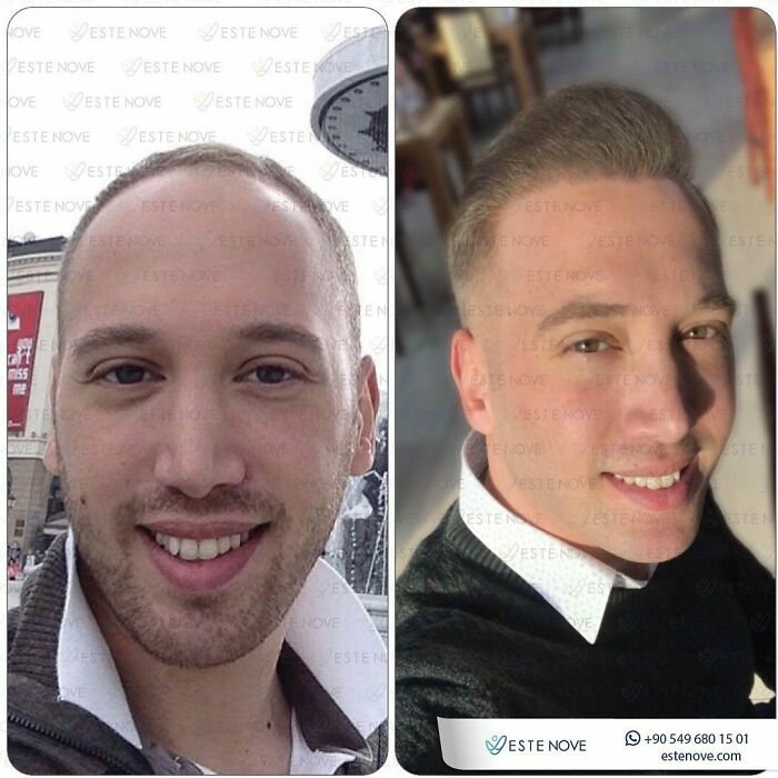 Side-by-side before and after photos showing hair transplant results on a smiling man with improved hair density.