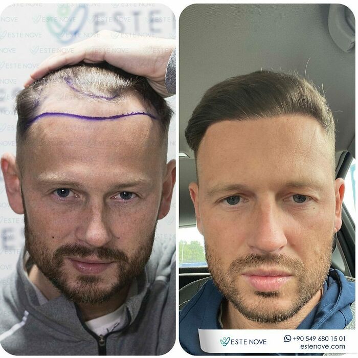 Before and after hair transplant showing restored hairline and thicker hair in a male patient with visible procedure markings.