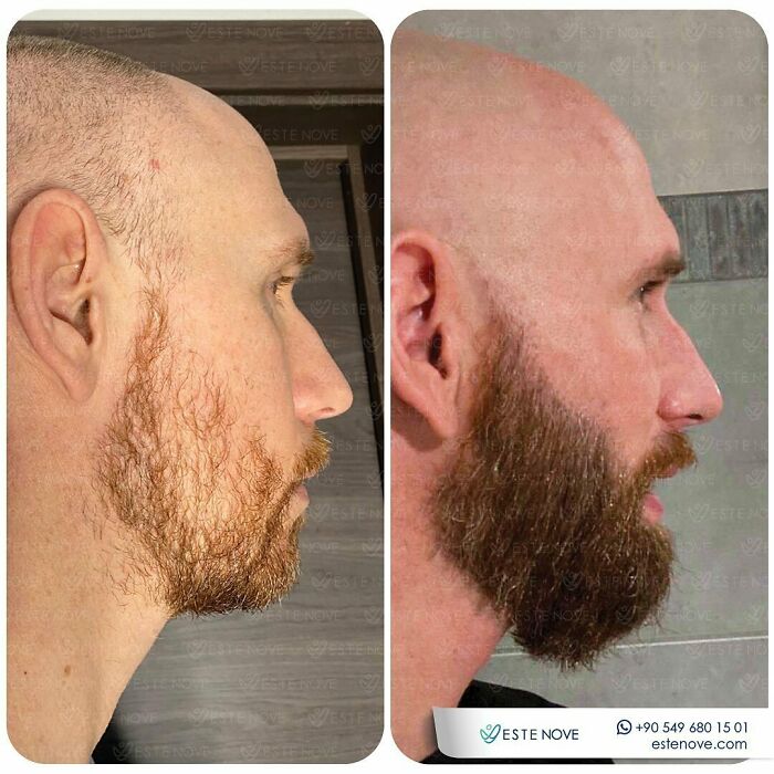 Before and after images showing hair transplant results on a man with improved hair density and fuller beard growth.