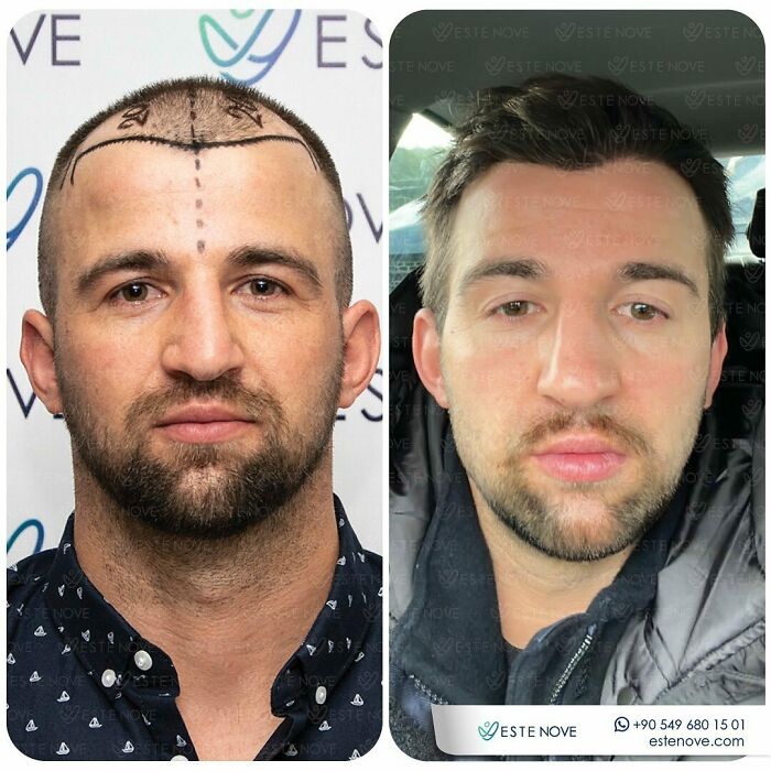 Before and after hair transplant images showing a man’s hairline restoration and fuller hair results by experienced surgeons.