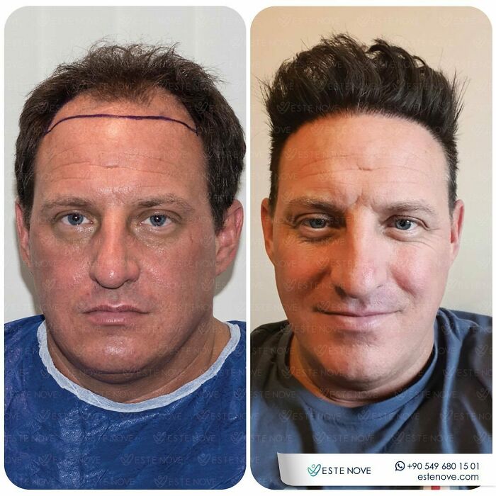 Before and after hair transplant photos showing restored hairline and thicker hair on a middle-aged man’s scalp.