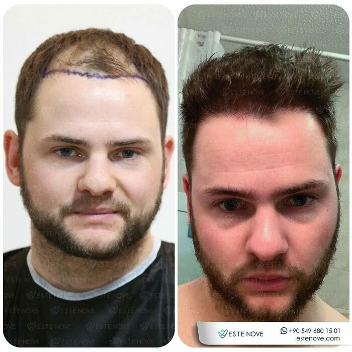 Before and after photos showing the effectiveness of a hair transplant with improved hairline and density results.