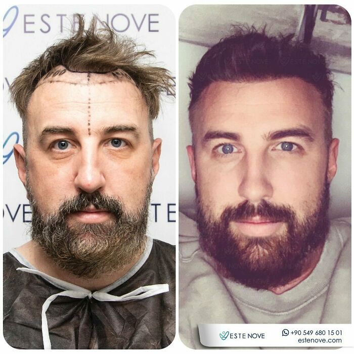 Before and after photos showing hair transplant results on a man with improved hairline and fuller hair restoration.