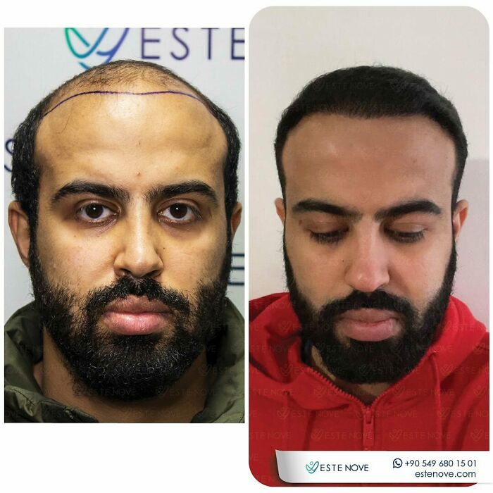 Before and after hair transplant photos showing significant hair restoration results on a male patient’s scalp.