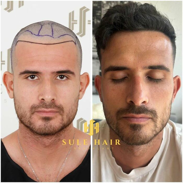 Before and after hair transplant photos showing improved hairline and fuller hair on a man's scalp and face.